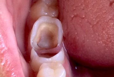 Blocos Porcelana - Cury Odontologia 1