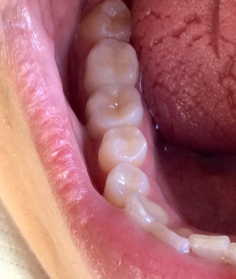 Blocos Porcelana - Cury Odontologia 2