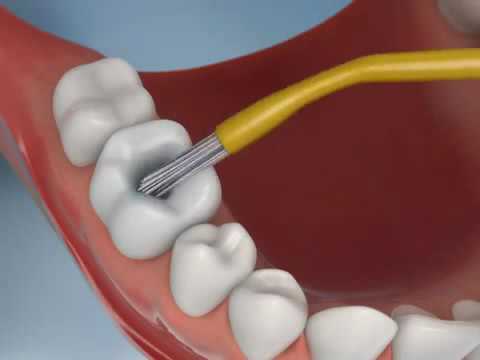 Procedimento de restauração dentária