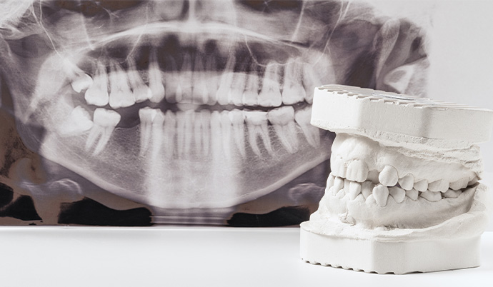 raio-x e um molde de uma arcada dentária