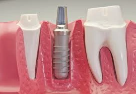 Como é feito um implante dentário?
