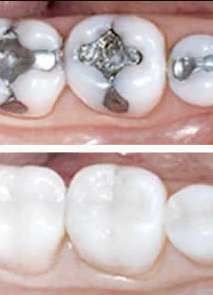 Exemplo de uma restauração dental