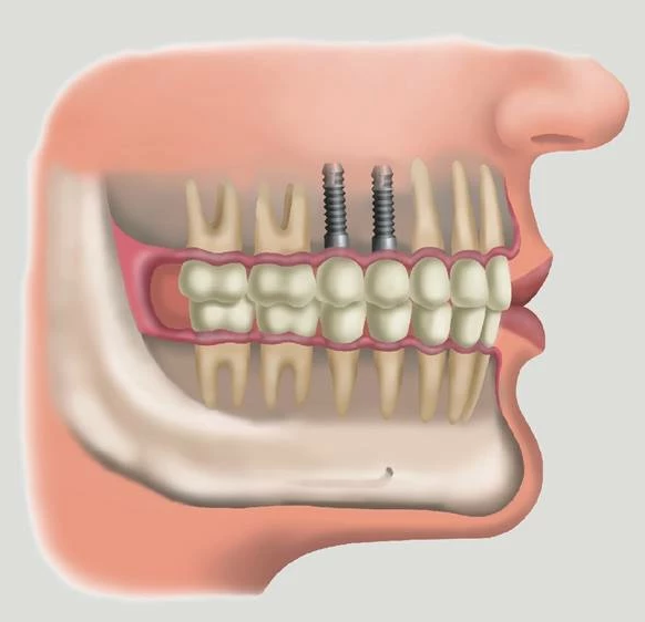 Implantes dentários em Curitiba